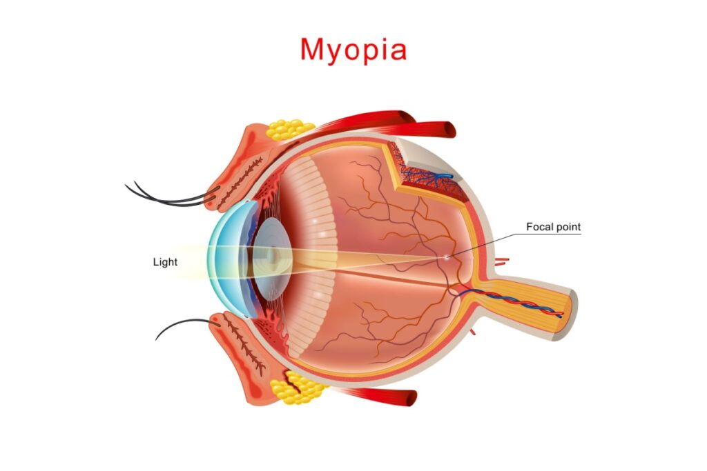 Medical illustration labeled Myopia showing a cross-section of a human eye with light focusing in front of retina.